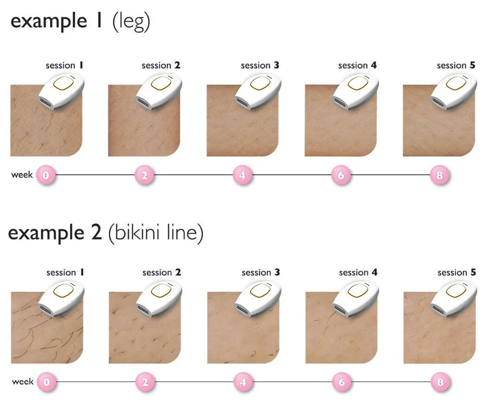 Laser Hair Removal Device – Model 881