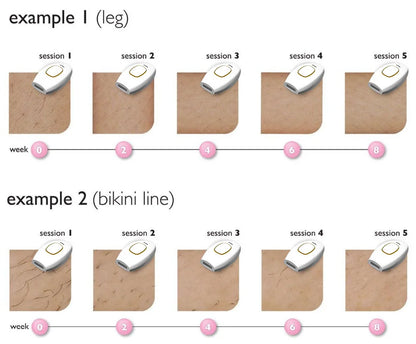 Laser Hair Removal Device – Model 881